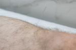 Кетгут-терапия для снижения веса с кетгут-нитями Кетгут-терапия для снижения веса с кетгут-нитями
