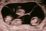 Один случай на 15,5 миллиона: в Петербурге родилась четверня девочек. Доктор Мухина — о женском здоровье