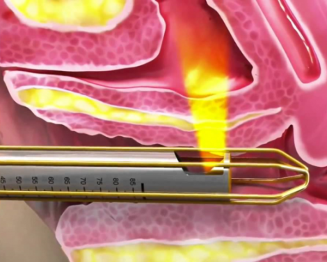 Лазерное интимное омоложение (воздействие фракционным СО2-лазером вагинально)