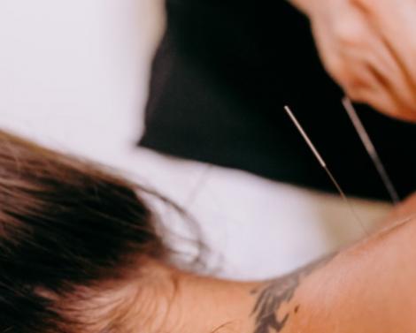 Иглоукалывание для похудения: как работает метод «Золотая игла» — вопросы и ответы Иглоукалывание для похудения: как работает метод «Золотая игла» — вопросы и ответы