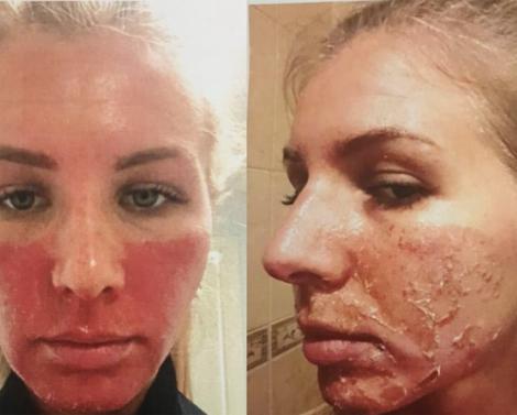 «Я не открывала рот из страха, что кожа лопнет»: петербурженка требует компенсацию от солярия, где получила ожоги